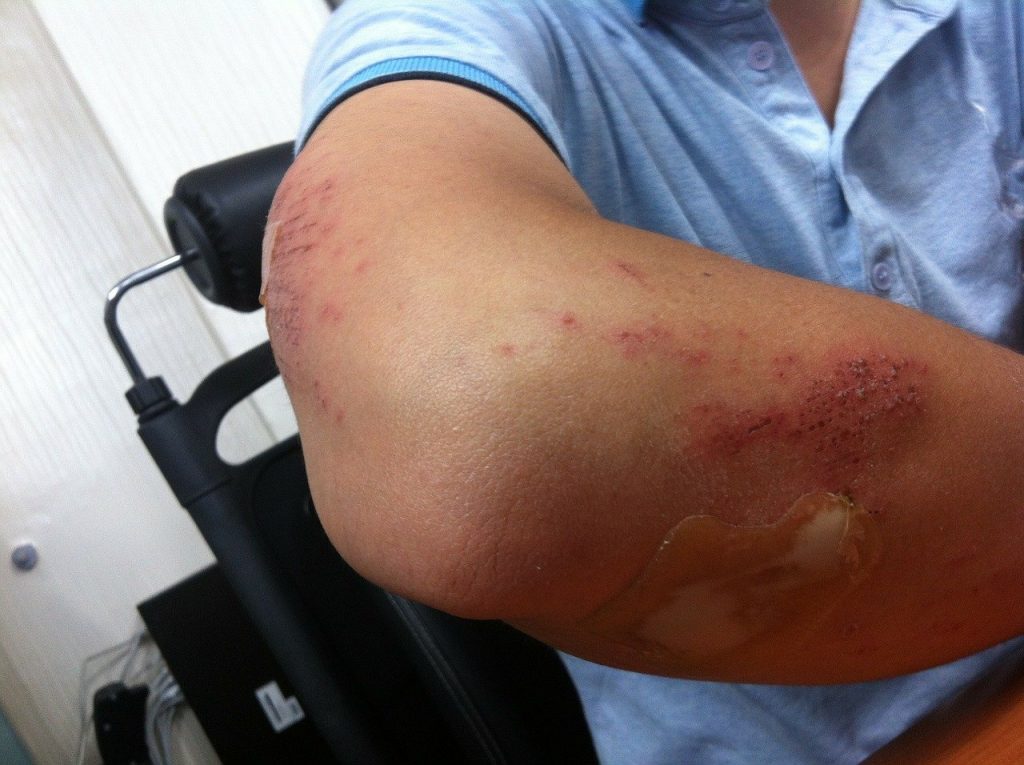 Can I sue The Rental Company For Accident Injuries In Florida?