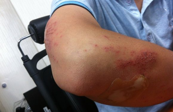 Can I sue The Rental Company For Accident Injuries In Florida?
