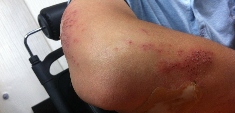 Can I sue The Rental Company For Accident Injuries In Florida?